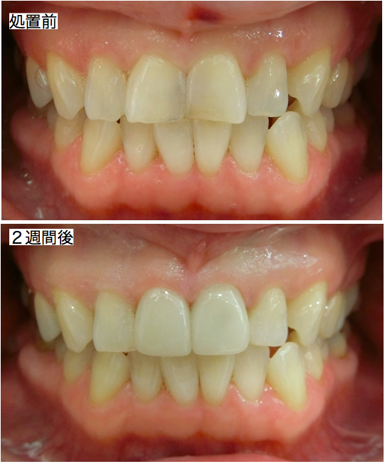 前歯部審美治療