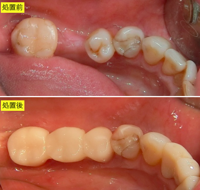 臼歯部審美治療