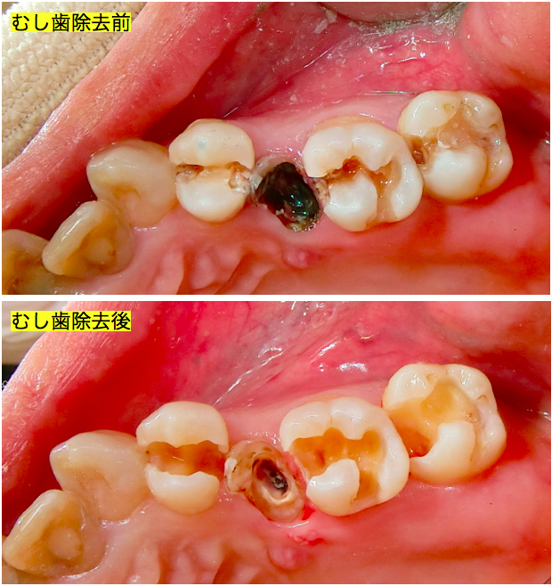 むし歯除去前後
