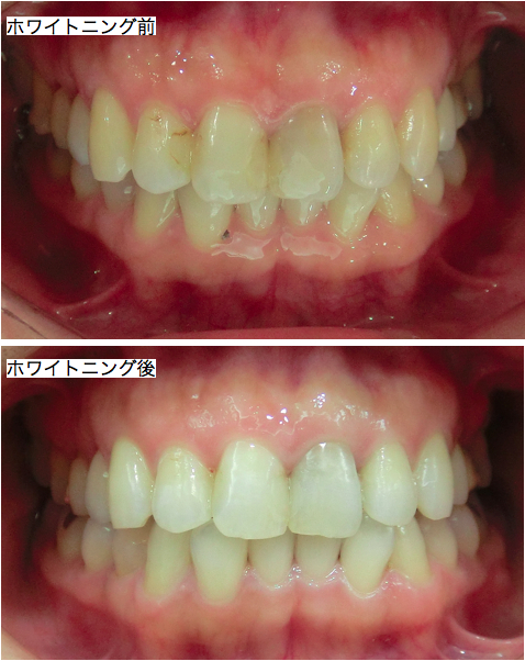 ホワイトニング前後