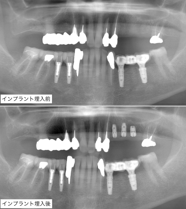 インプラント術前術後