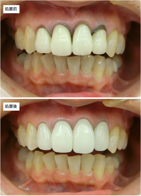 セラミック処置前後