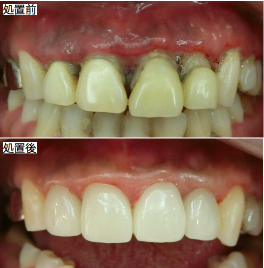 前歯部審美治療