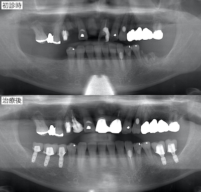 治療後パノラマ