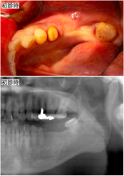 インプラント術前