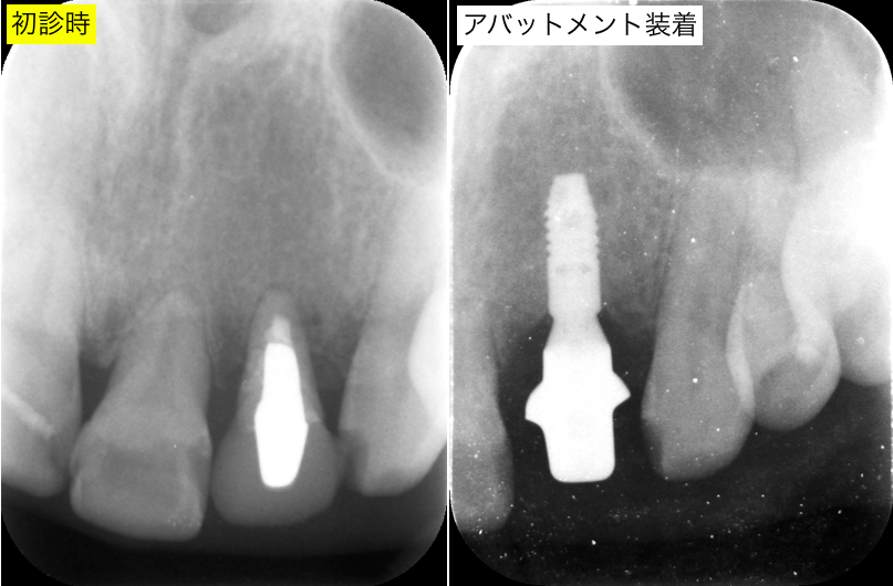 インプラント