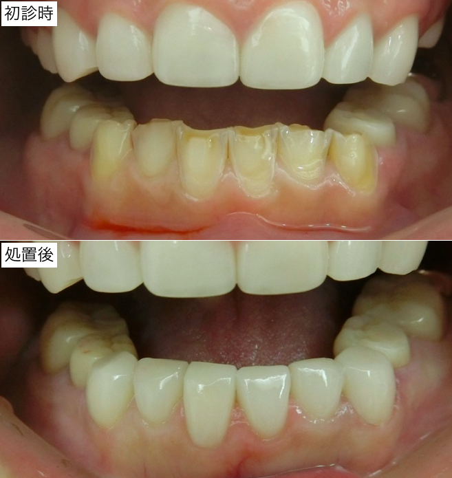 前歯部審美治療