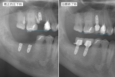 右上レントゲン
