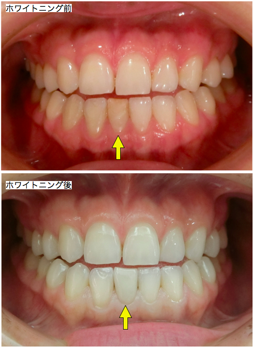 ホームホワイトニング