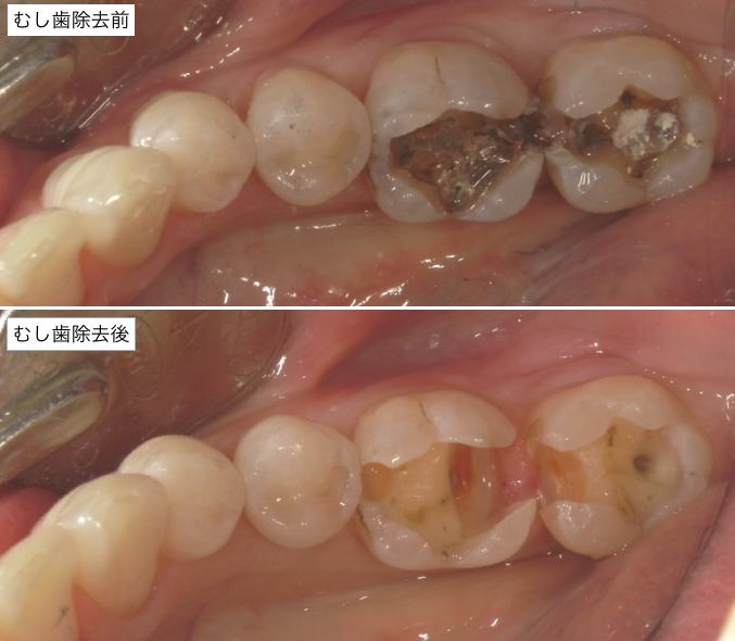 むし歯除去