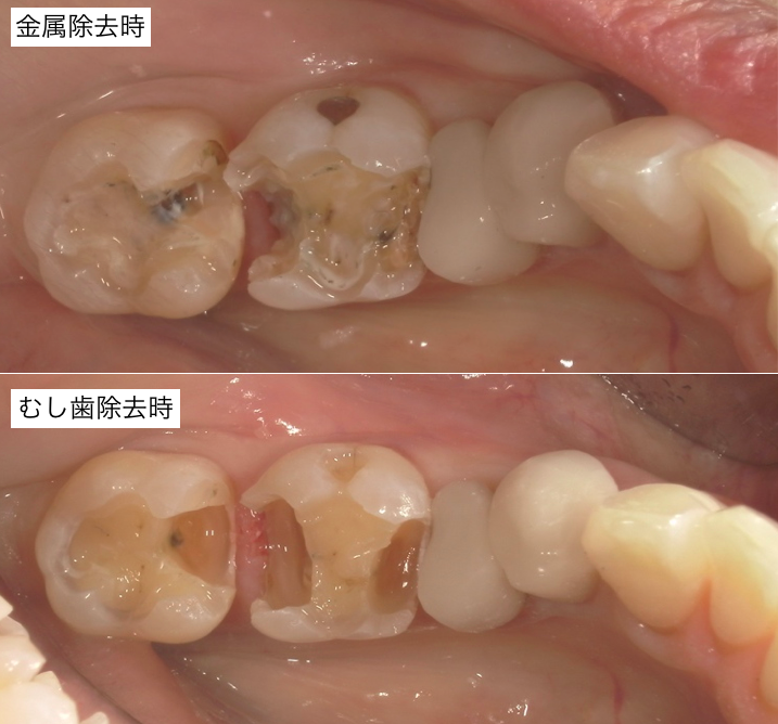 むし歯除去