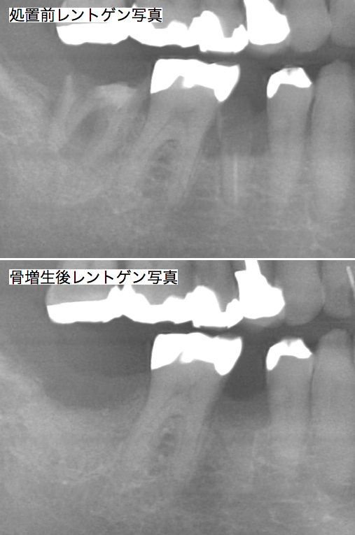 インプラント