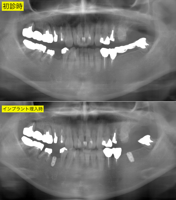 インプラント術前術後