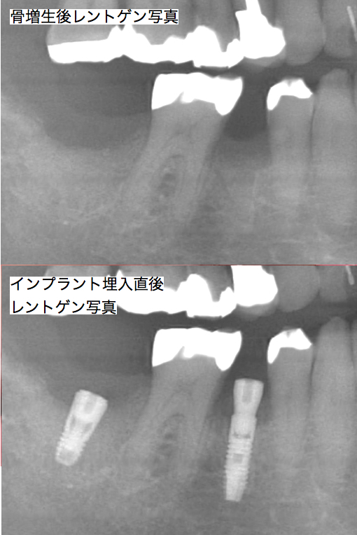 インプラント