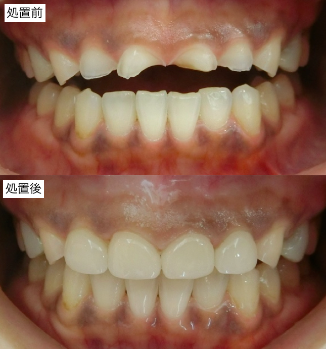 前歯部審美治療