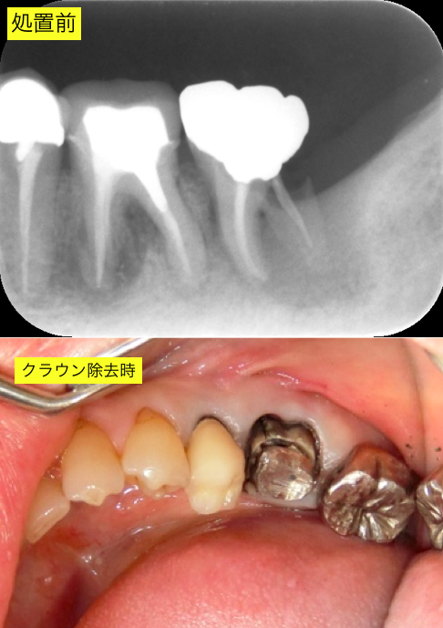 左下初診時