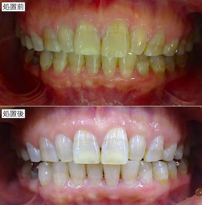 ホームホワイトニング