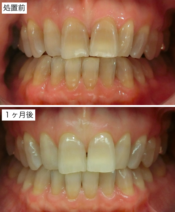 ホームホワイトニング