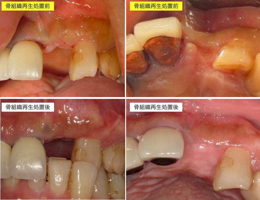 インプラント術前