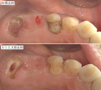 虫歯治療
