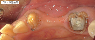 ブリッジ除去時