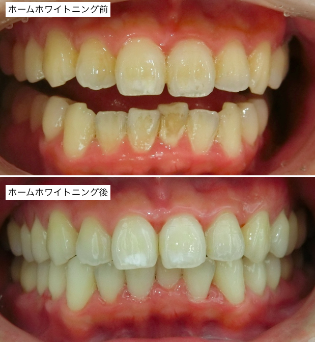 ホームホワイトニング