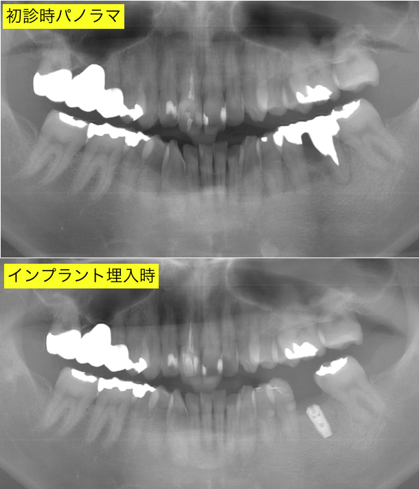 インプラント術後