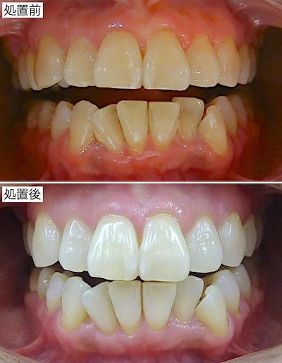ホームホワイトニング