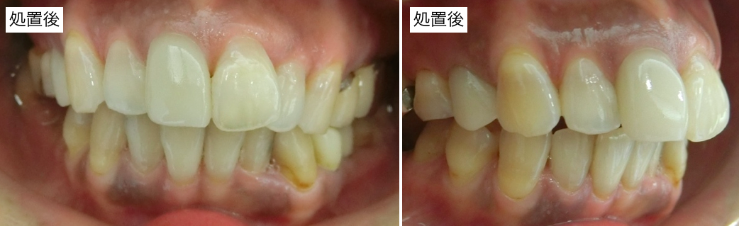 前歯部審美治療