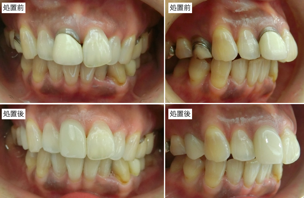 前歯部審美治療