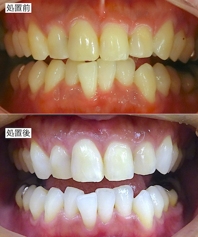 ホームホワイトニング