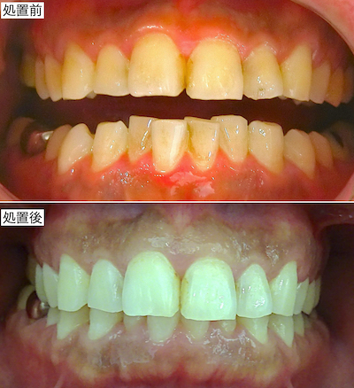 ホームホワイトニング