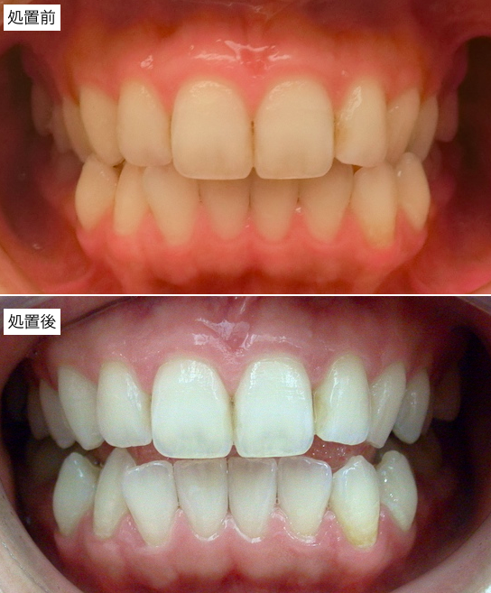 ホームホワイトニング