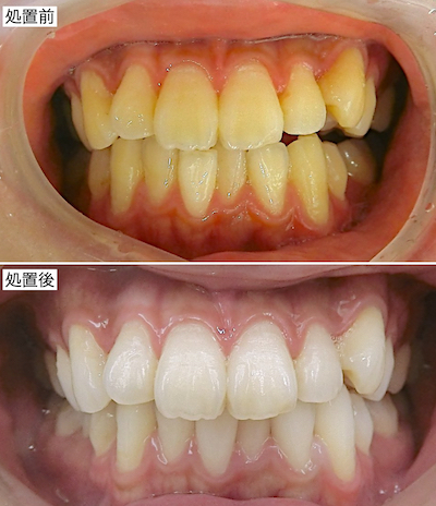 ホームホワイトニング