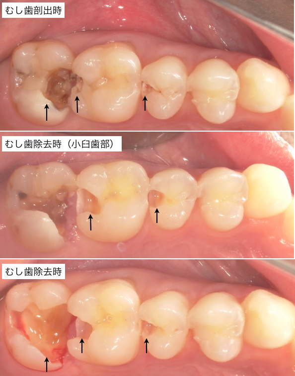 むし歯除去