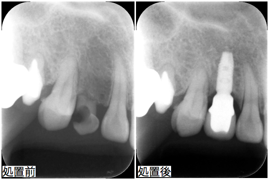 レントゲン処置前後