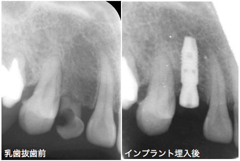 インプラント