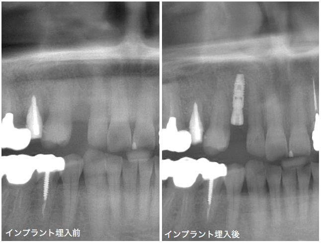インプラント