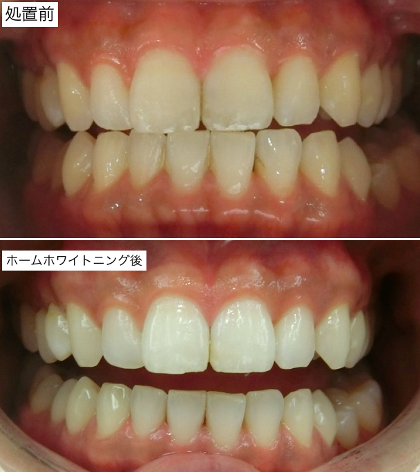 ホームホワイトニング