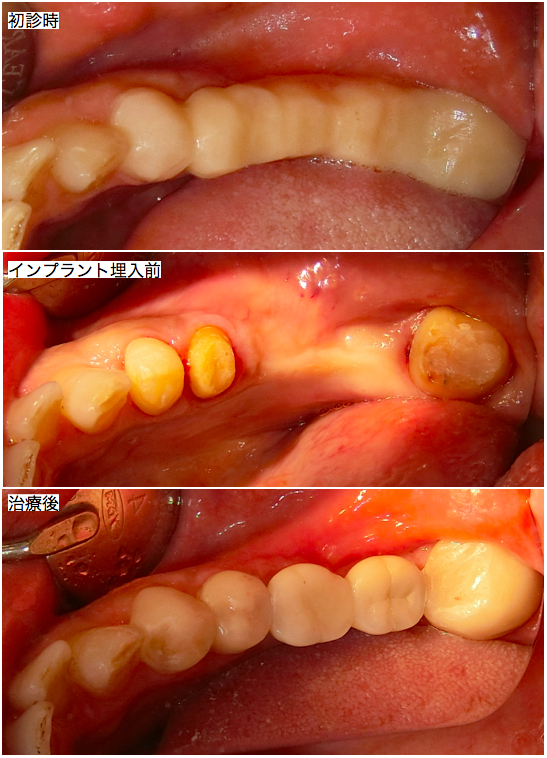 インプラント処置後