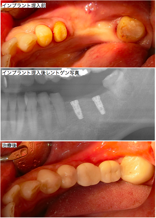 インプラント治療後