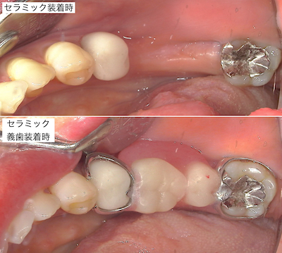 セレック治療