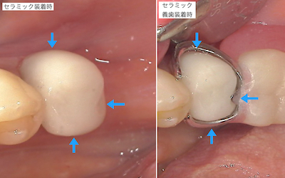 セレック治療