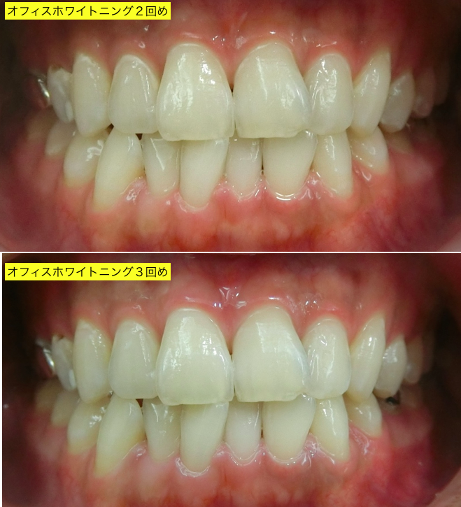オフィスホワイトニング２回め