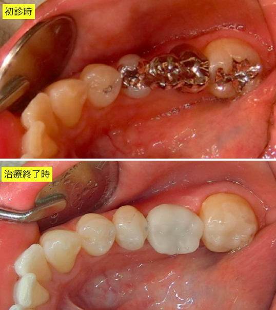 インプラント術前術後