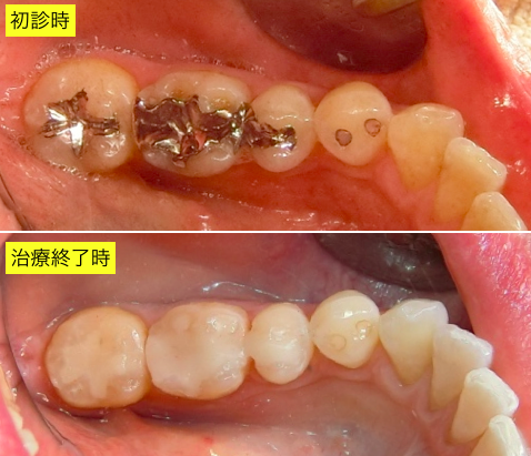 セレック治療