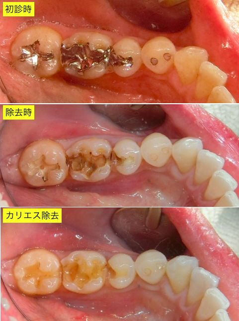 セレック治療