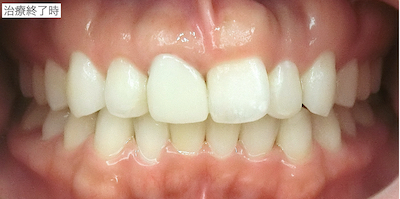 セラミッククラウン 