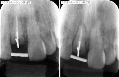 エクストルージョン