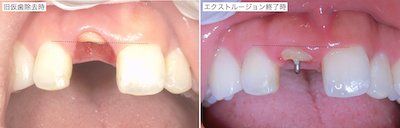 エクストルージョン